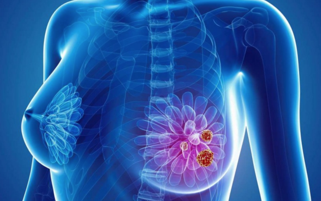 Traditional Chinese Medicine’s popularity among breast cancer patients worldwide