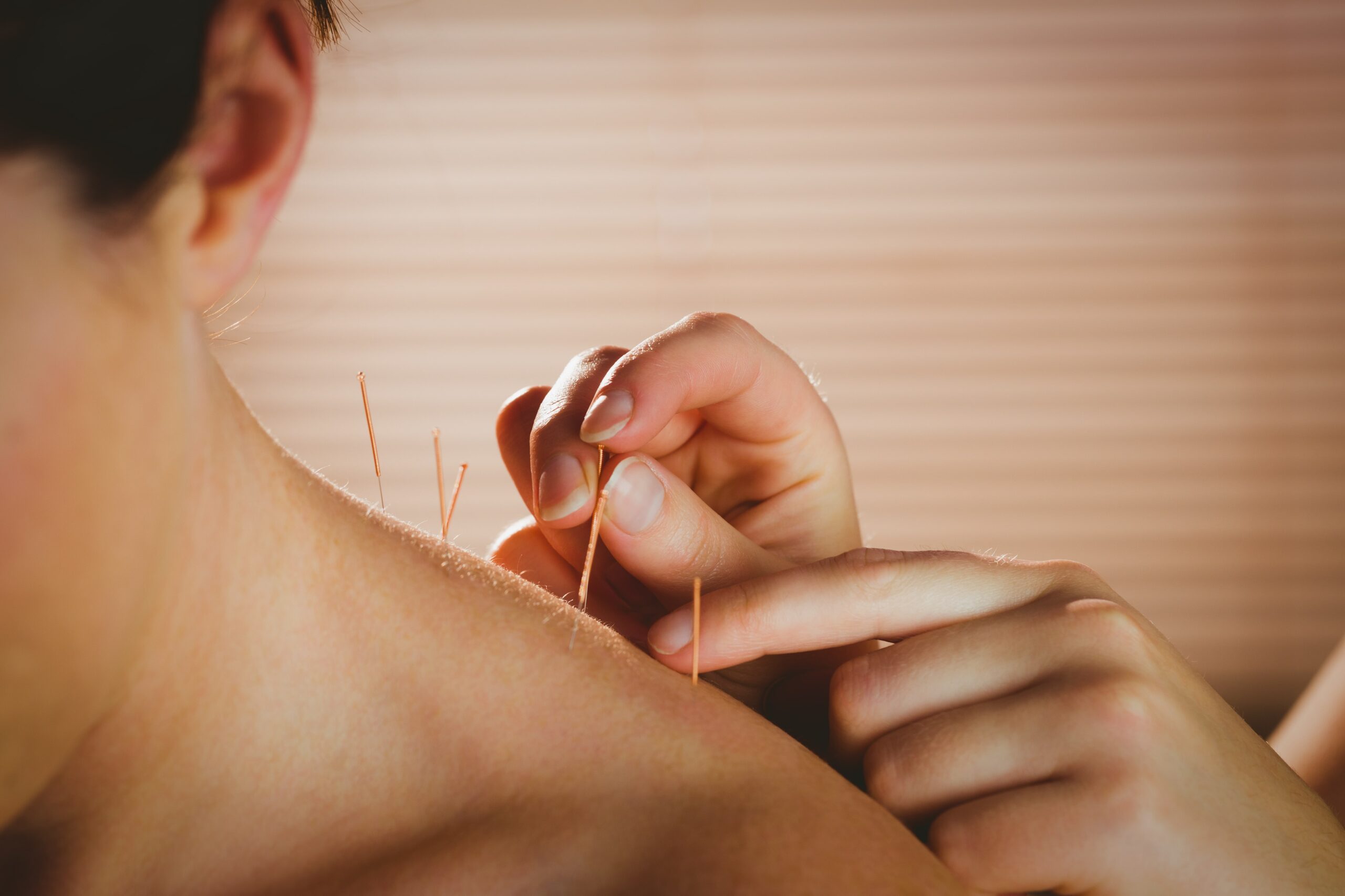 5 Benefits of Acupuncture in Cancer Care 