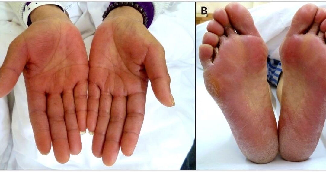 Care For Hand-Foot Syndrome (HFS)